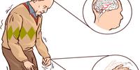 Morbo di Parkinson: nuova tecnica con gli ultrasuoni per fermare i tremori